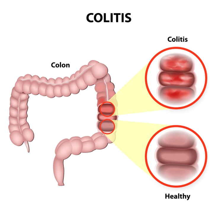 Ulcerative Colitis • Victory Brokerage, Inc., helping agents write life